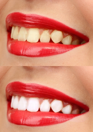 Bleaching