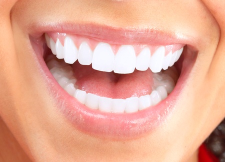Veneers